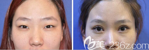 江油白天鹅整形美容医院余强双眼皮术前术后对比图