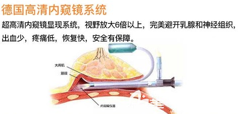 内窥镜隆胸的示意图