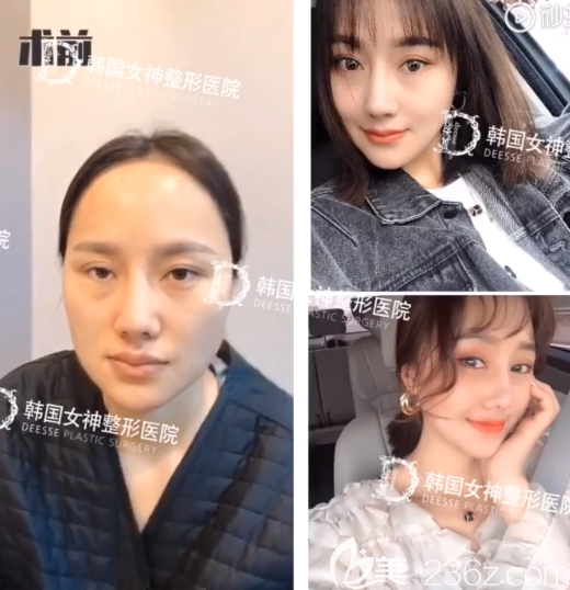韩国女神医院轮廓真人案例 韩国女神医院轮廓真人案例