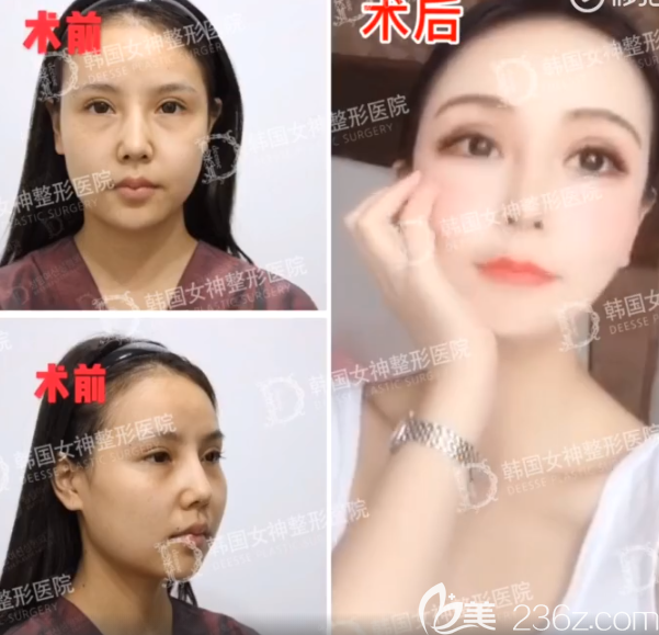 女神医院轮廓3件套 术前+术后6个月 女神医院轮廓3件套 术前+术后6个月