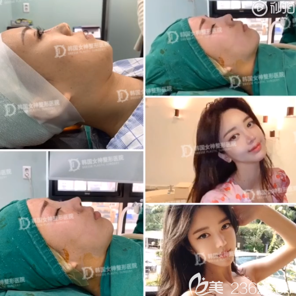 韩国女神隆鼻真人案例 韩国女神隆鼻真人案例