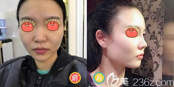 嘉兴禾美美容医院彭建隆鼻案例