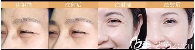 在南通康美做除皱前后对比