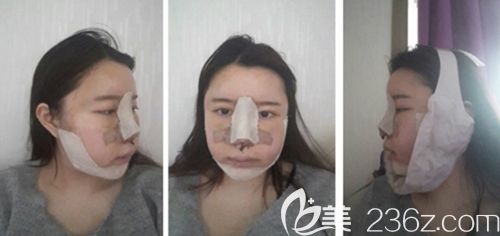 在韩国新帝瑞娜做眼鼻整形+面部轮廓手术后2天