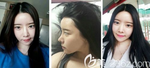 在韩国新帝瑞娜做眼鼻整形+面部轮廓手术后1个月
