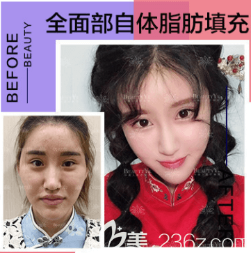 北京叶美人自体脂肪面部填充多少钱？丁雅晴面部脂肪填充7199元起含案例