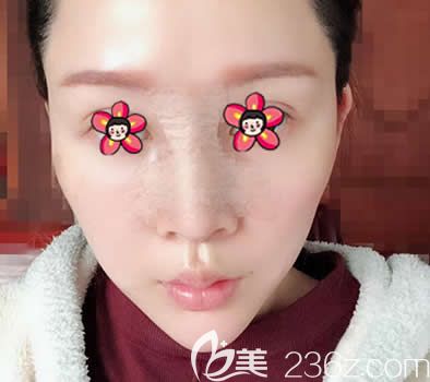 嘉兴禾美整形曹海峰隆鼻案例即刻效果