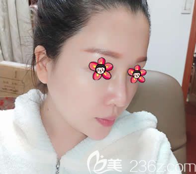 嘉兴禾美整形做硅胶隆鼻案例