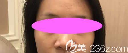 我没在吉安天使做鼻综合手术前的照片 我没在吉安天使做鼻综合手术前的照片