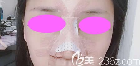 我找吉安天使王小辉做肋骨鼻综合术后第3天效果 我找吉安天使王小辉做肋骨鼻综合术后第3天效果