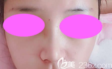 我找吉安天使王小辉做肋骨鼻综合术后第9天效果 我找吉安天使王小辉做肋骨鼻综合术后第9天效果