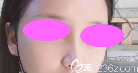 我找吉安天使王小辉做肋骨鼻综合术后第28天效果 我找吉安天使王小辉做肋骨鼻综合术后第28天效果