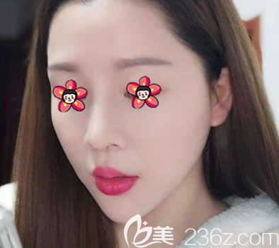嘉兴禾美整容医院鼻综合隆鼻案例