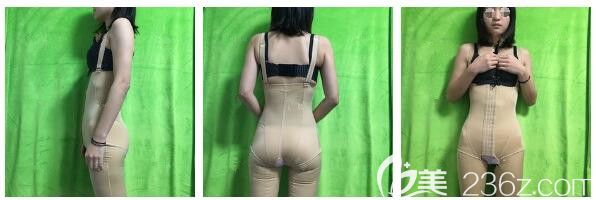 朱如岗医生建议做完水动力腰腹部吸脂术后穿着塑身衣 朱如岗医生建议做完水动力腰腹部吸脂术后穿着塑身衣