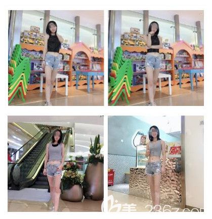 到南通俪人连天美做腰腹部吸脂术后效果 到南通俪人连天美做腰腹部吸脂术后效果