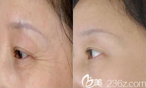 韩国ls整形美容外科去皱案例效果对比图