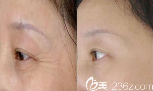 韩国LS整形美容外科洪荣晙院长眼部除皱案例效果对比图