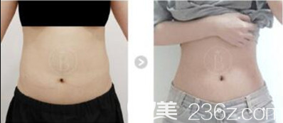 韩国babiline医院郑熙妍院长腰腹吸脂案例效果对比图