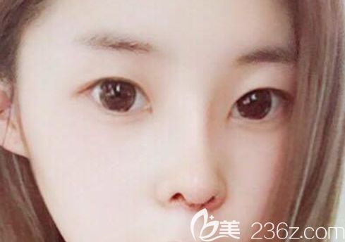 呼市五洲王焕假体隆鼻+自体软骨隆鼻第五天图片