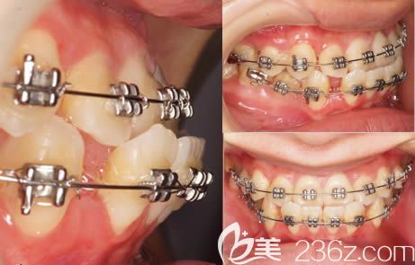 在<!--<i data=20240703-sp></i>-->口腔做正畸前的牙齿反颌照片 在<!--<i data=20240703-sp></i>-->口腔做正畸前的牙齿反颌照片