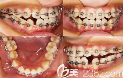 在<!--<i data=20240703-sp></i>-->口腔矫正3个月时照片 在<!--<i data=20240703-sp></i>-->口腔矫正3个月时照片