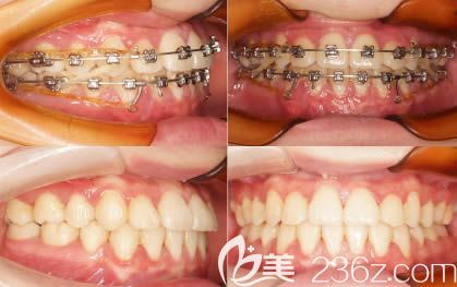 地包天矫正一年没效果，后转诊口腔才解除我的牙齿反颌