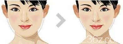 什么是面部吸脂