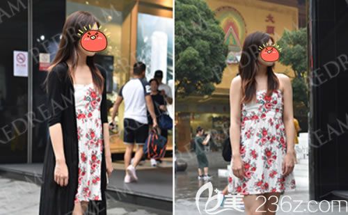 杭州薇琳医院做假体隆胸术前 杭州薇琳医院做假体隆胸术前