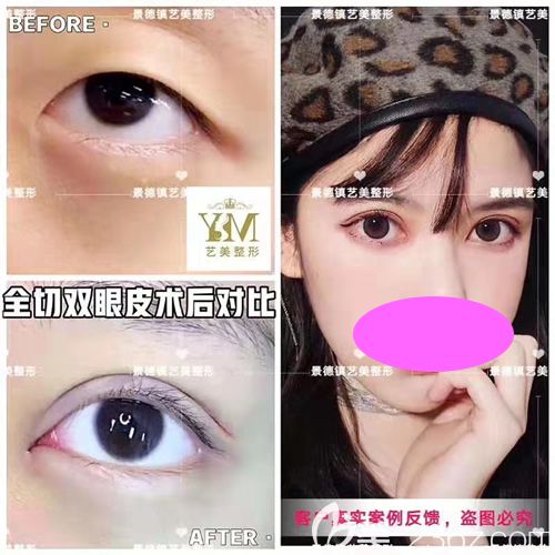 景德镇艺美整形虞国锋全切双眼皮一个月恢复效果图