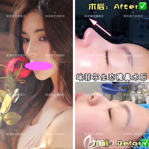 景德镇艺美整形虞国锋埃菲尔生态隆鼻案例效果图