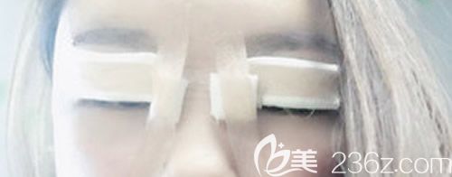 我找景德镇艺美虞国锋割7mm开扇形双眼皮术后即刻图