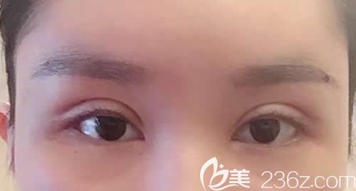 我找景德镇艺美虞国锋割7mm开扇形双眼皮术后第7天效果图