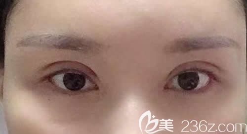 我找景德镇艺美虞国锋割7mm开扇形双眼皮术后第10天恢复效果图