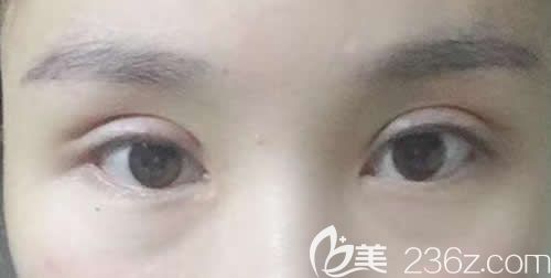 我找景德镇艺美虞国锋割7mm开扇形双眼皮术后第22天恢复效果图