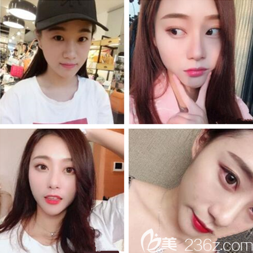 遵义利美康双眼皮怎么样