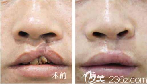 <!--<i data=20240703-sp></i>-->唇裂鼻畸形治疗效果