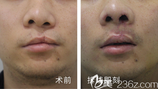 <!--<i data=20240703-sp></i>-->唇腭裂鼻畸形