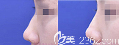 韩国奥来OLE整形外科医院洪基锡驼峰鼻矫正案例 韩国奥来OLE整形外科医院洪基锡驼峰鼻矫正案例