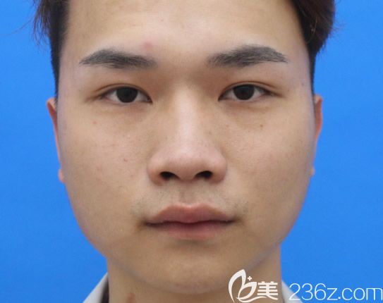 包头华美整形医院隆鼻前 包头华美整形医院隆鼻前