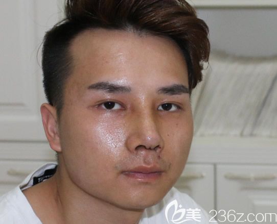 自体肋软骨综合隆鼻第7天拆线后图片 自体肋软骨综合隆鼻第7天拆线后图片