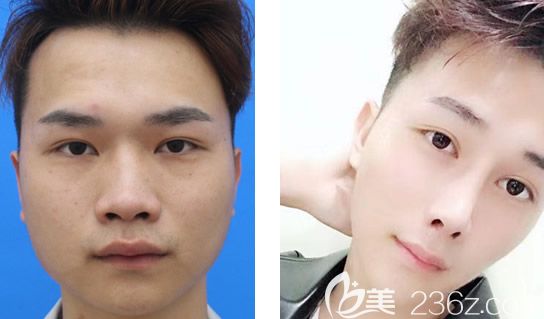 包头华美白虎男士隆鼻前后对比照片 包头华美白虎男士隆鼻前后对比照片