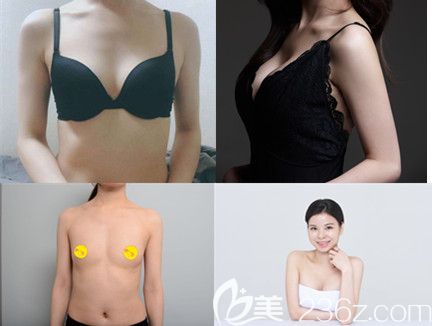 普罗菲耳隆胸案例 普罗菲耳隆胸案例