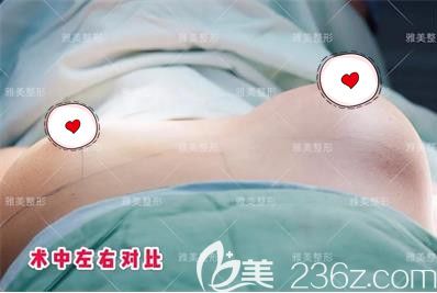 做完一侧傲诺拉假体隆胸的效果对比 做完一侧傲诺拉假体隆胸的效果对比