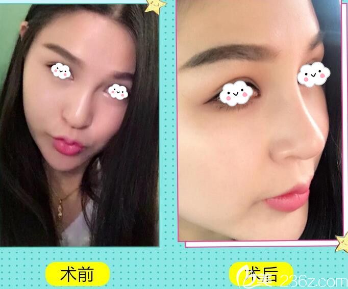 韩国丽侬整形医院鼻综合隆鼻案 例 韩国丽侬整形医院鼻综合隆鼻案 例