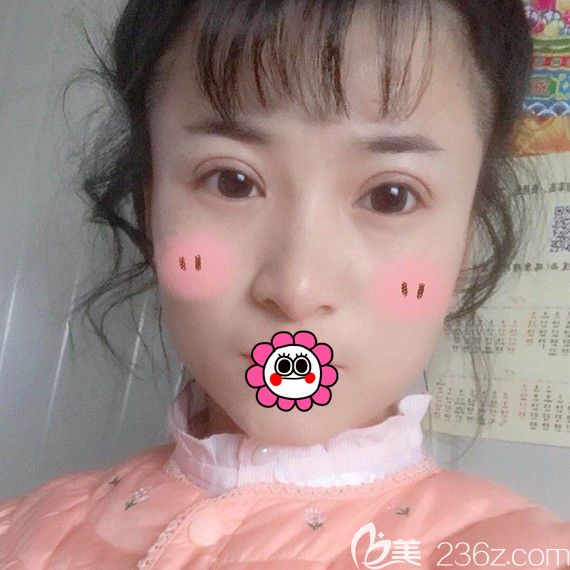 找哈尔滨臻美专注眼鼻修复的王丹丹做双眼皮修复后，明白了适合自己的才更好