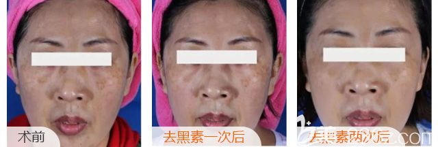 在苏州美贝尔做激光祛斑术后案例