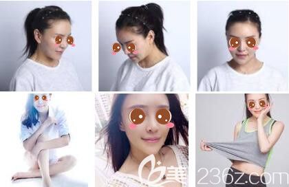 上海时光整形外科医院李桂海发际线种植真人案例 上海时光整形外科医院李桂海发际线种植真人案例