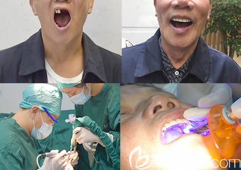 口腔种植牙案例效果图 口腔种植牙案例效果图