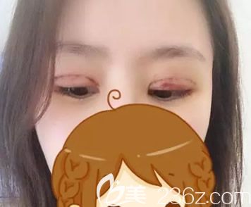 包头华美全切双眼皮+去皮去脂第三天效果 包头华美全切双眼皮+去皮去脂第三天效果