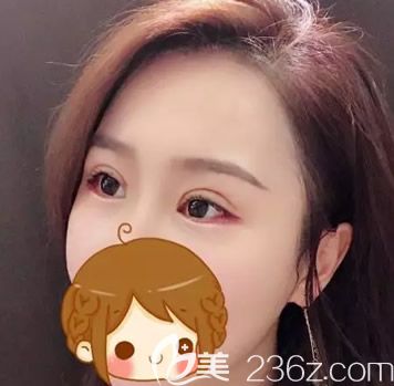 华美王金红切开双眼皮半个月图片 华美王金红切开双眼皮半个月图片